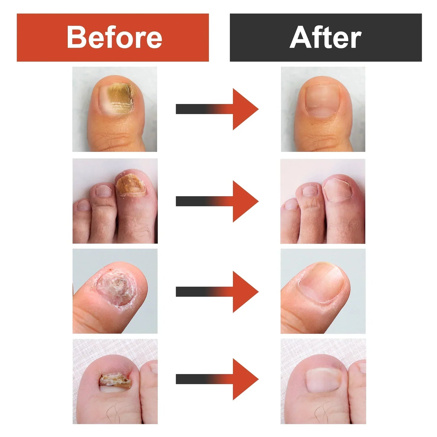 Nail Fungus Remover