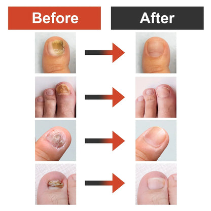 Nail Fungus Remover